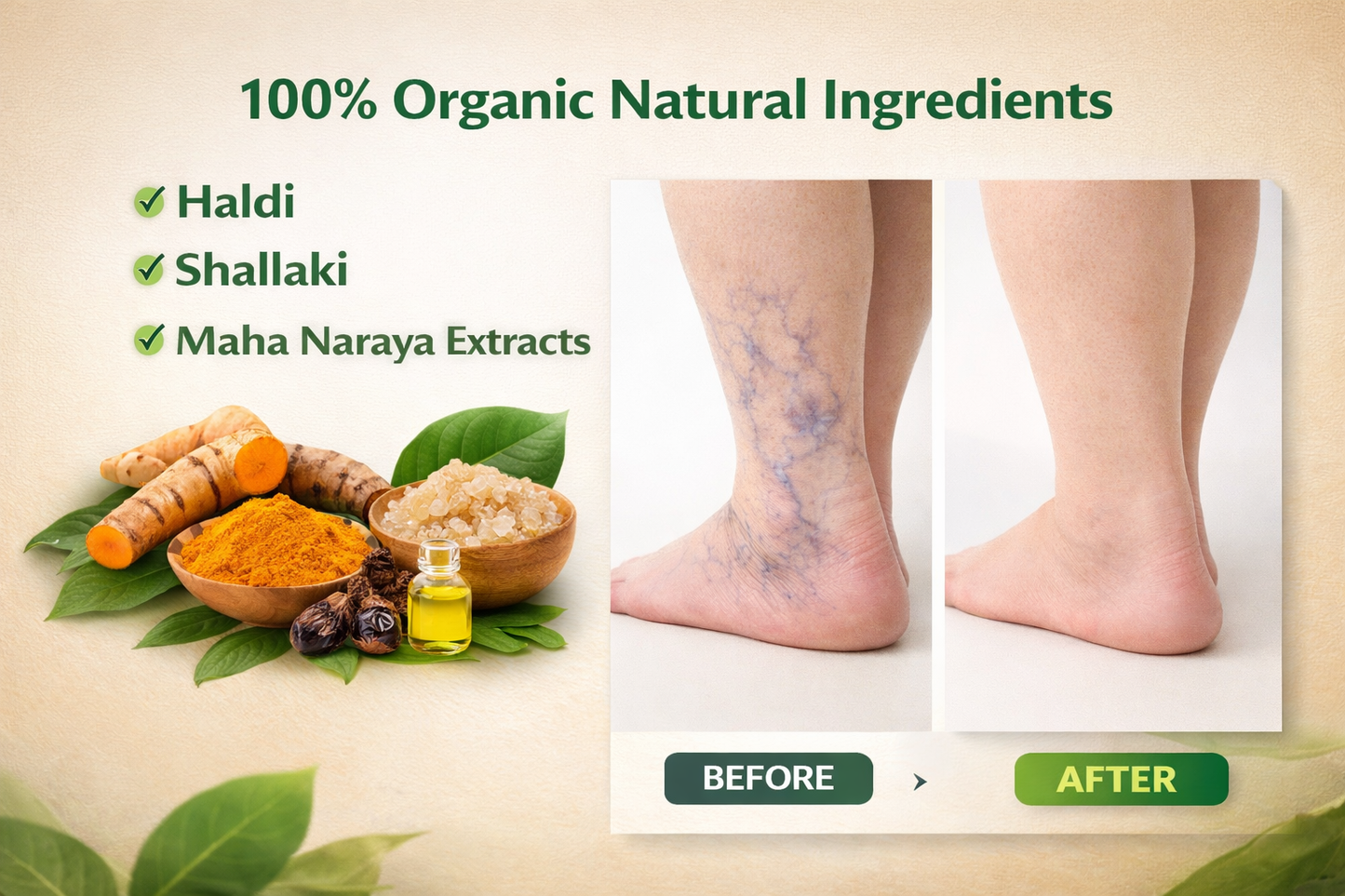 Heal Varicose Veins | Veda-Relief VV Spray