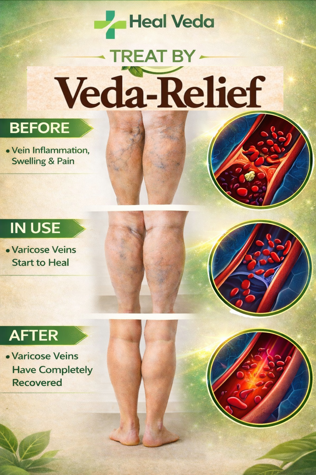 Heal Varicose Veins | Veda-Relief VV Spray